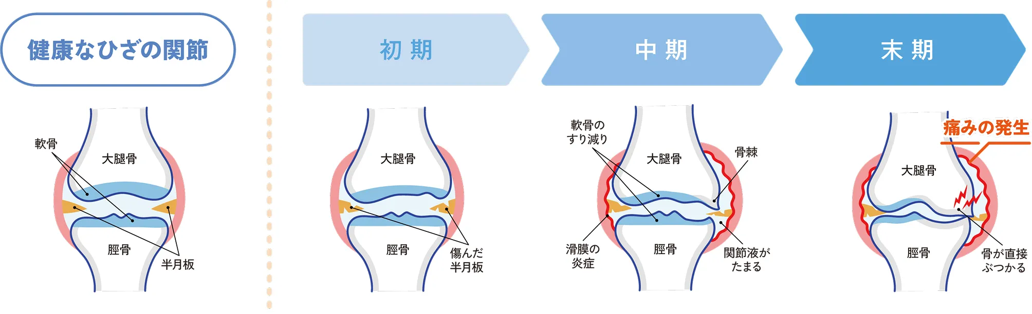 ひざ関節の変化を示す図:健康な状態から初期・中期・末期の変化(軟骨のすり減り、滑膜の炎症、骨棘、骨の接触による痛み)までを段階的に解説